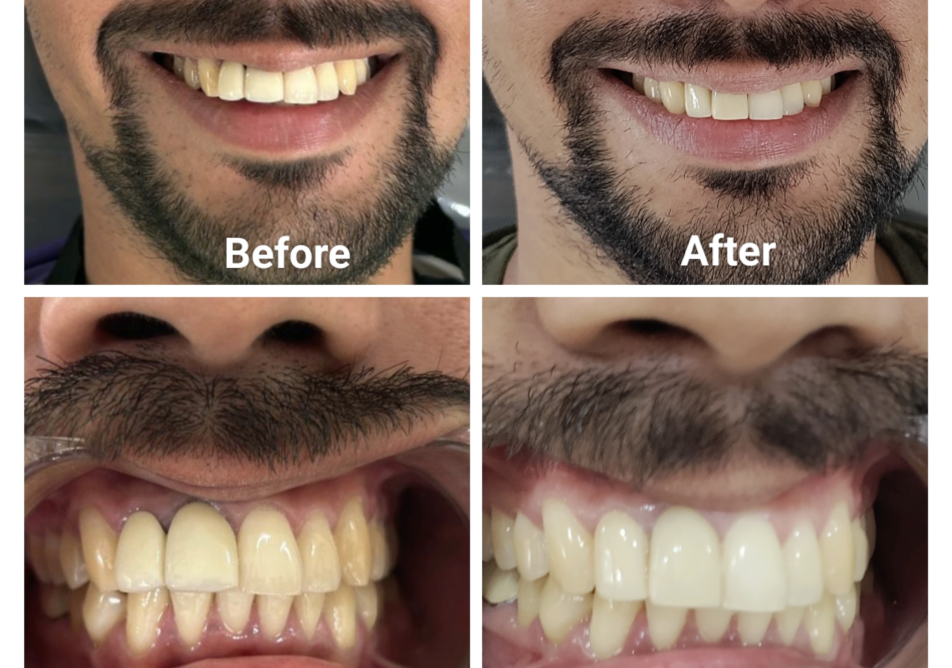 Ceramic Crowns