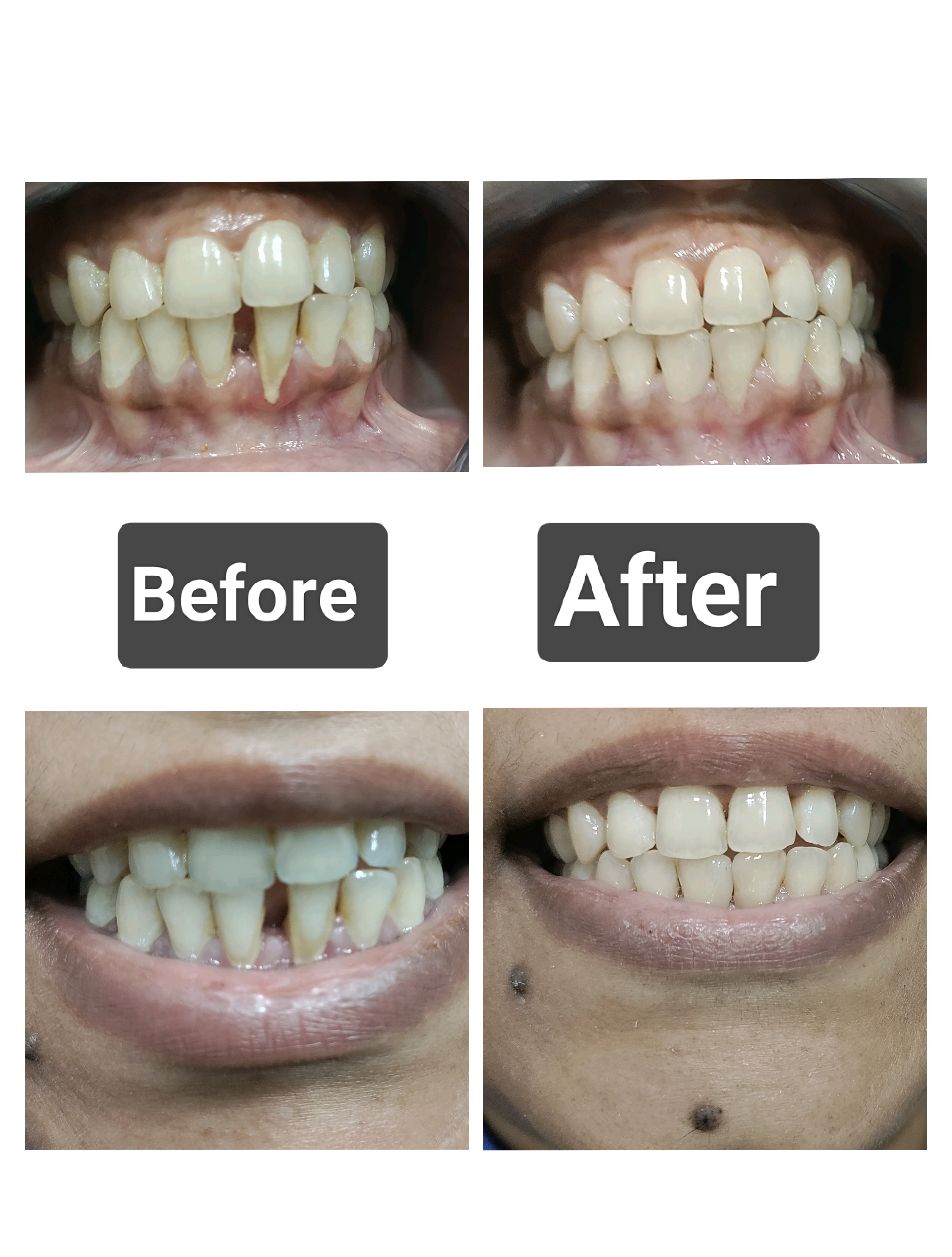 Scaling and Cleaning