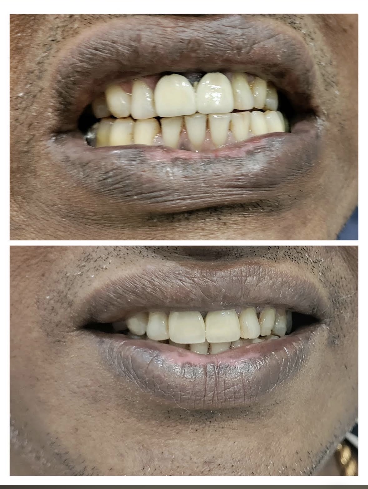 Root Canal Treatment