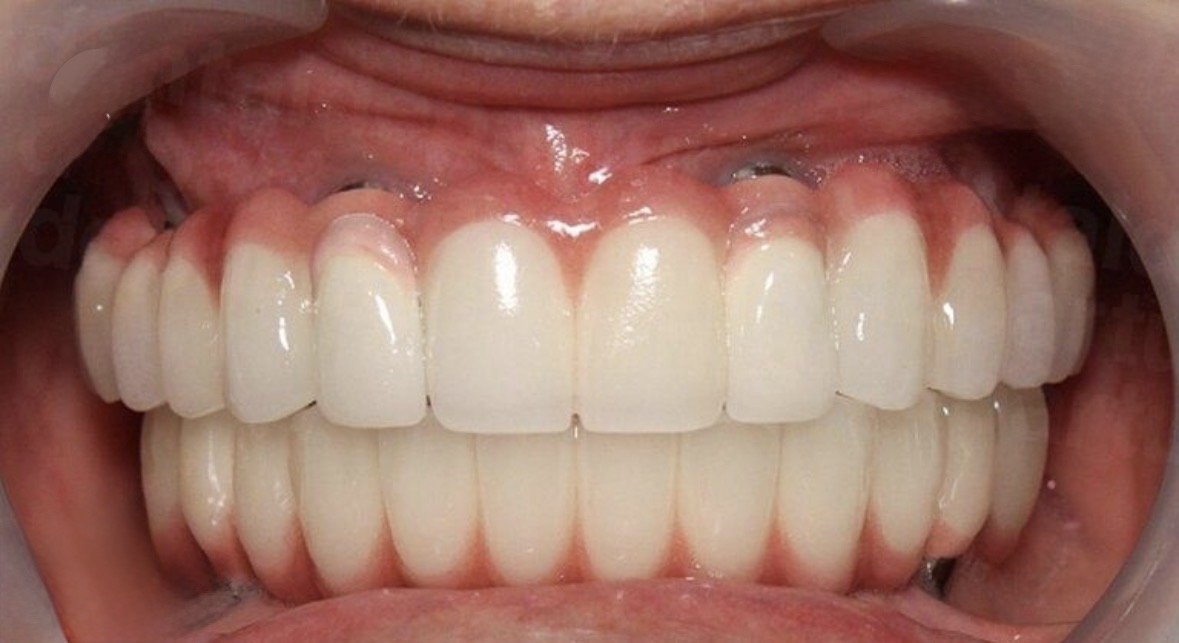 Full Mouth Rehabilitation