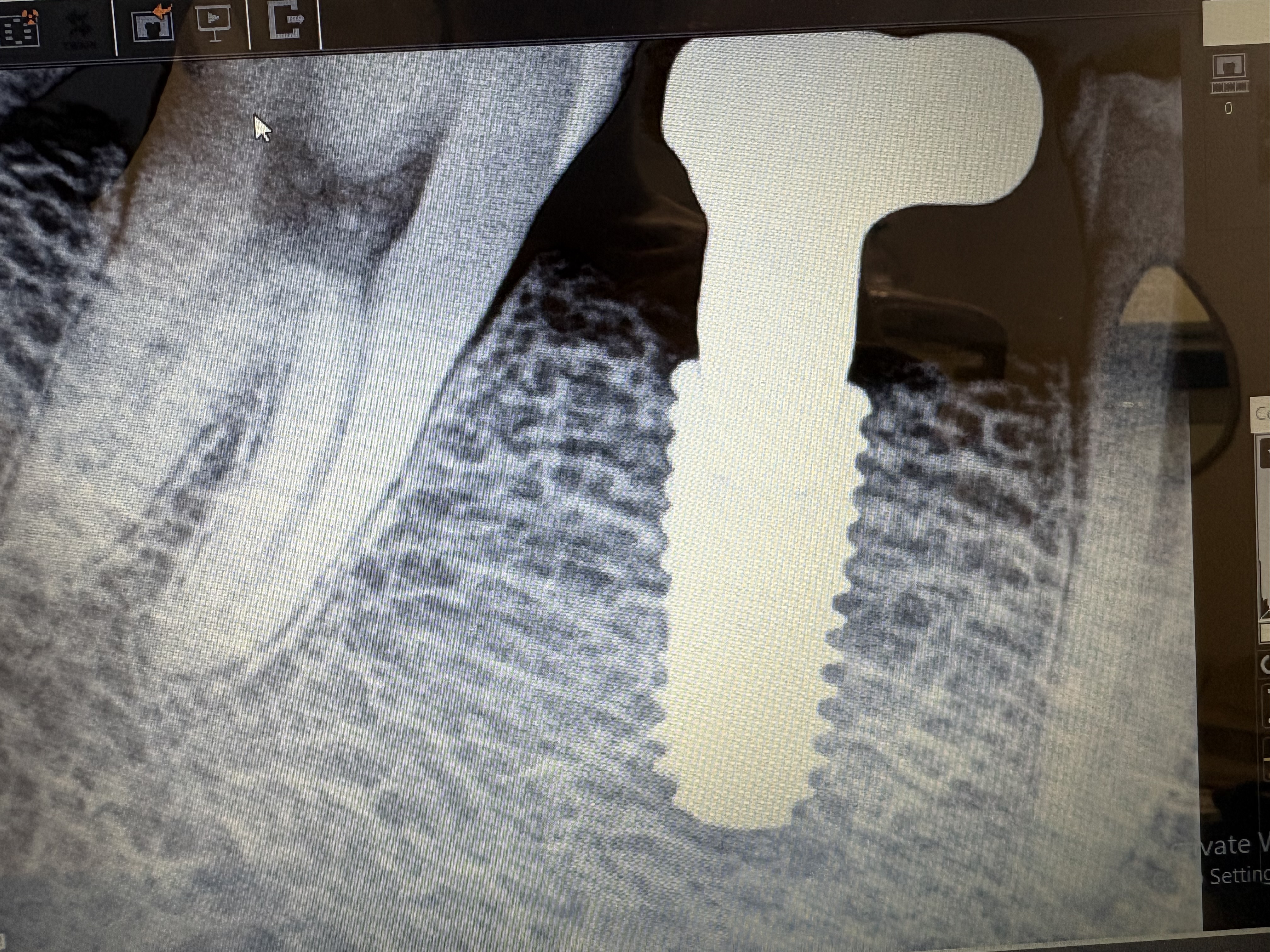 Dental Implants