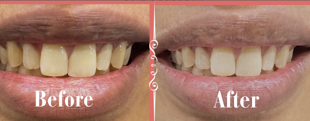 Teeth Whitening