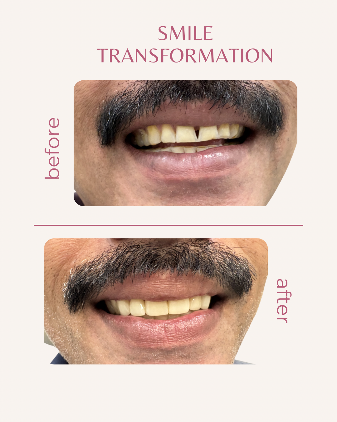 Smile Makeover